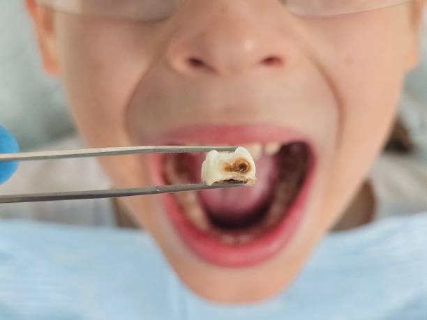 Best Emergency Tooth Extraction in Wyoming, DE